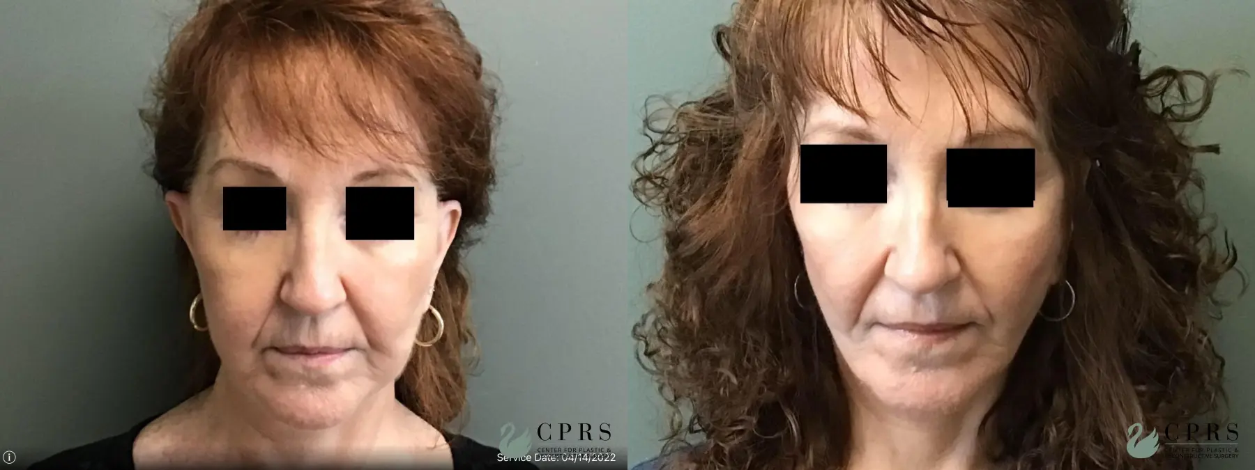 Facelift & Neck Lift: Patient 6 - Before and After  