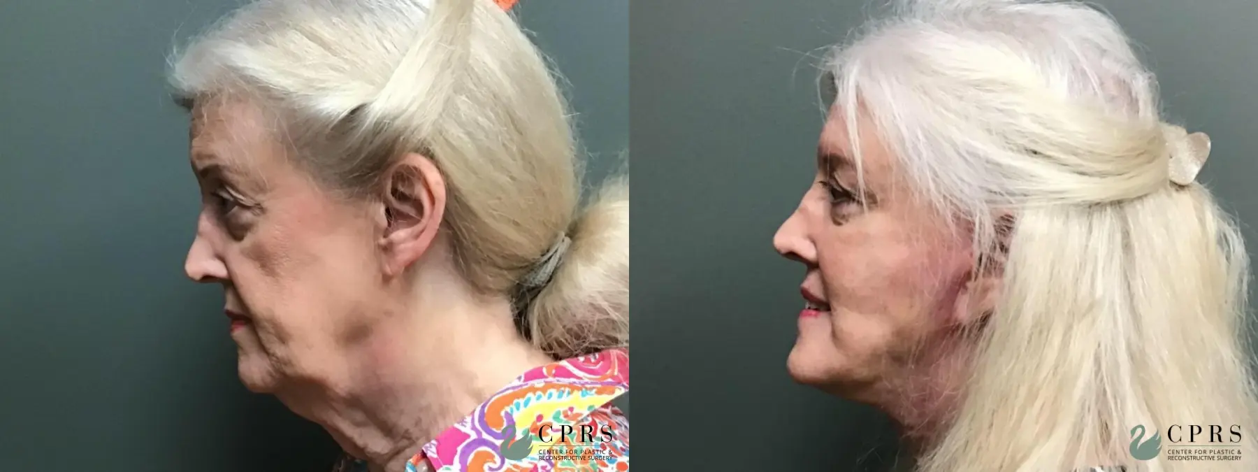 Facelift & Neck Lift: Patient 3 - Before and After 2