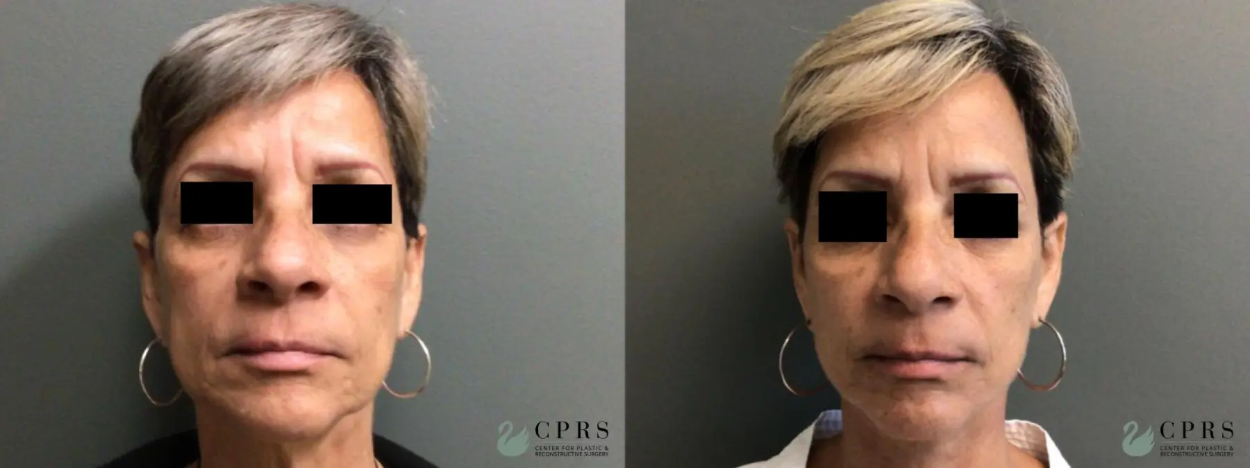 Facelift & Neck Lift: Patient 5 - Before and After  