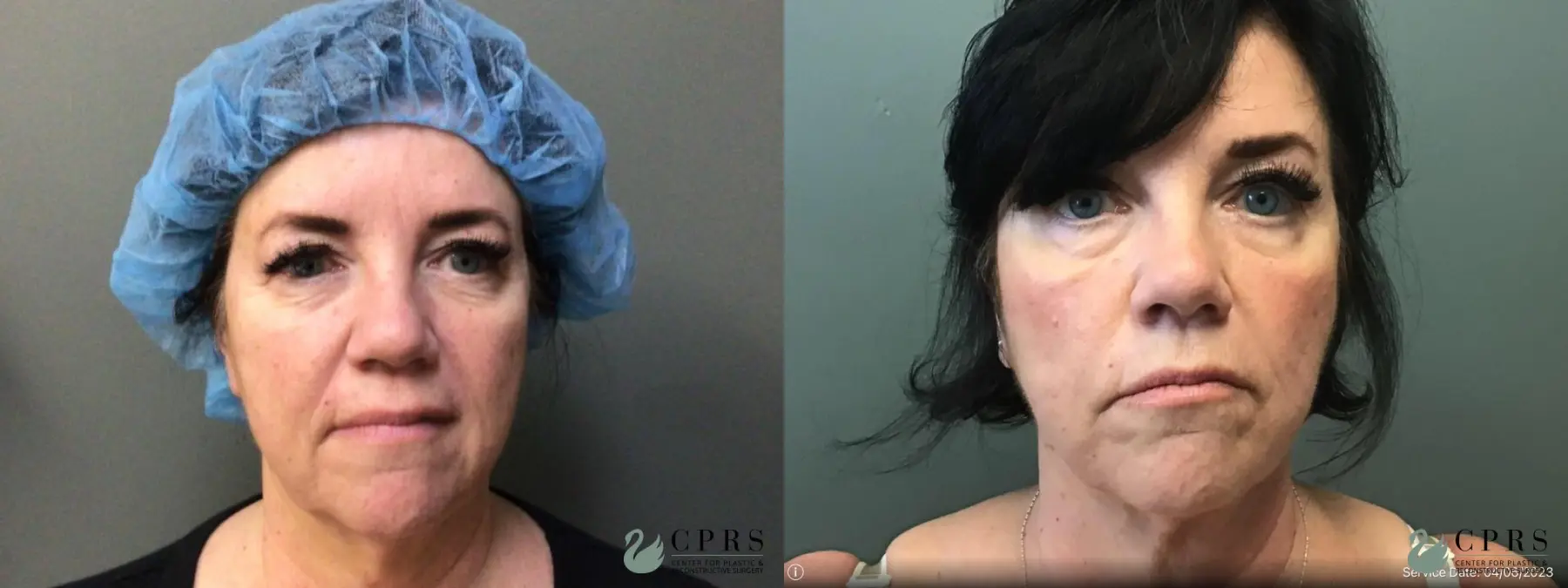 FaceTite: Patient 3 - Before and After  