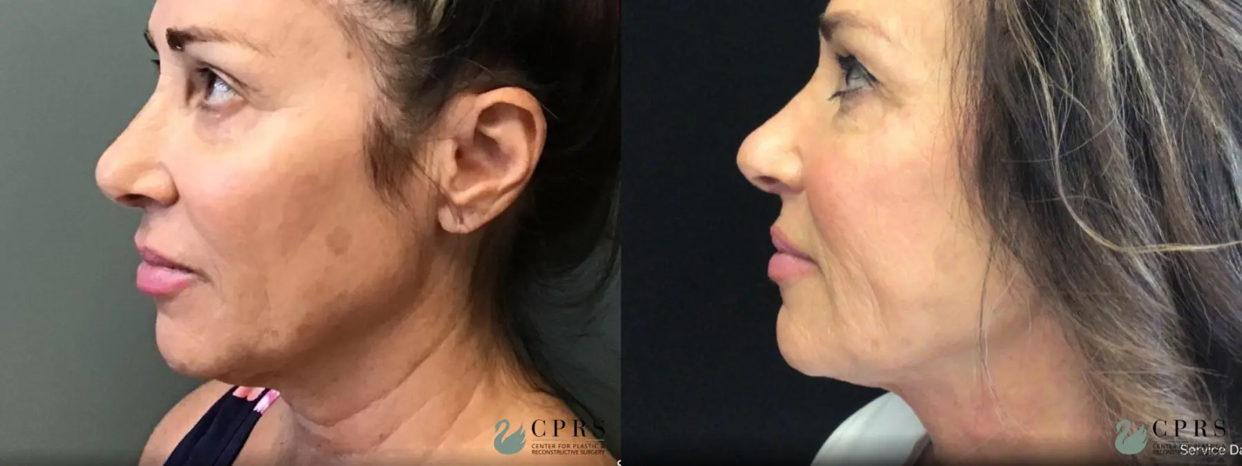 FaceTite: Patient 3 - Before and After  
