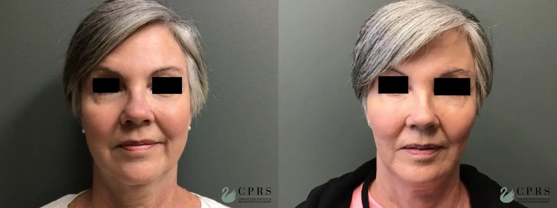 FaceTite: Patient 7 - Before and After 1