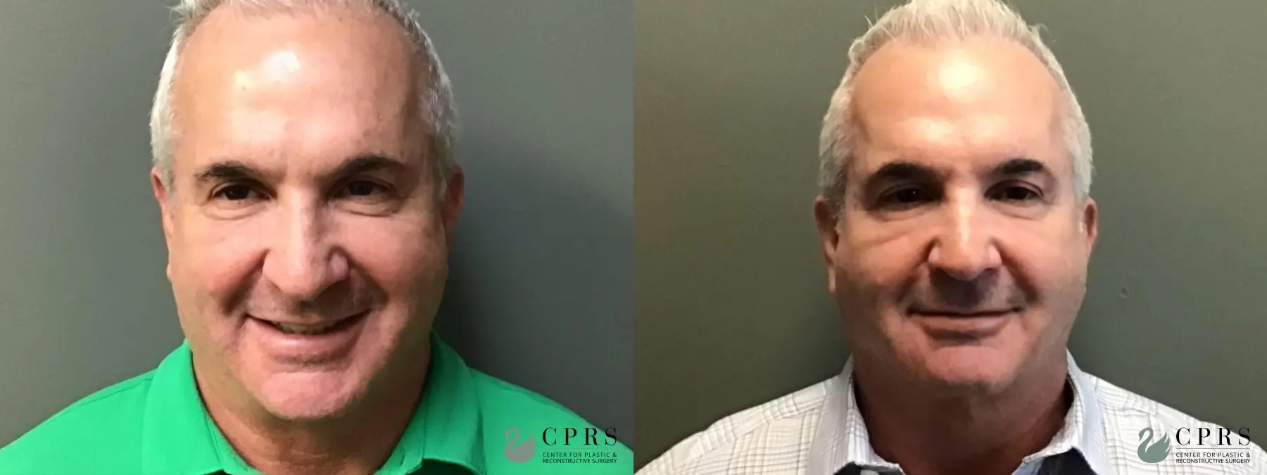 FaceTite: Patient 2 - Before and After  