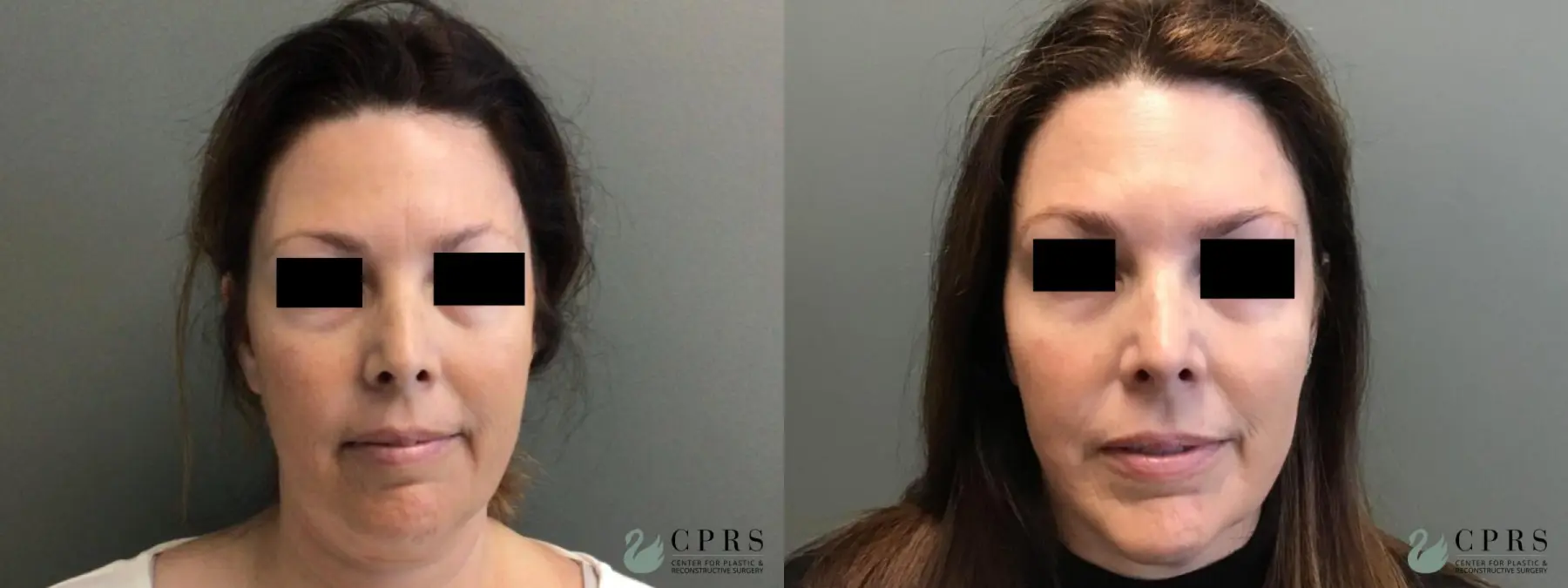 FaceTite: Patient 5 - Before and After 1