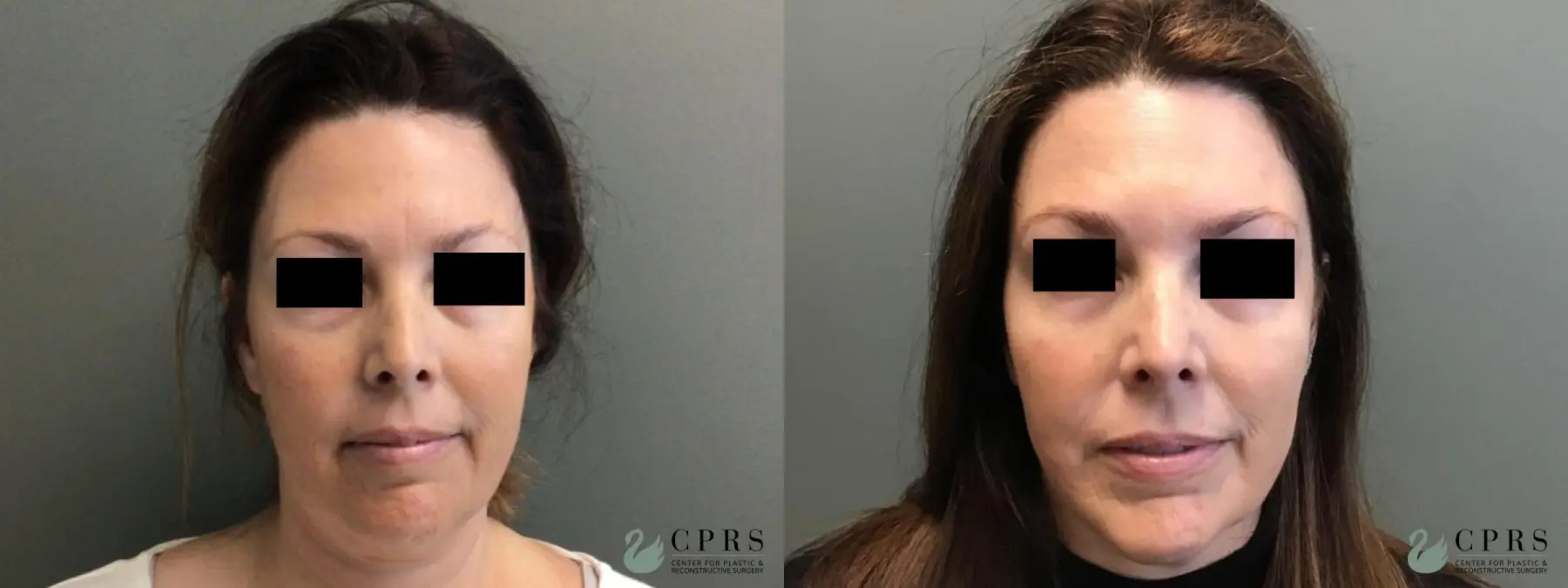 FaceTite: Patient 5 - Before and After  