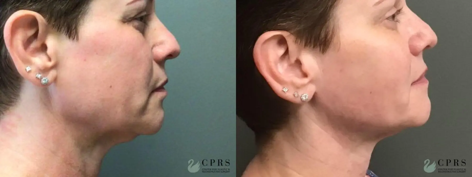 FaceTite: Patient 4 - Before and After  