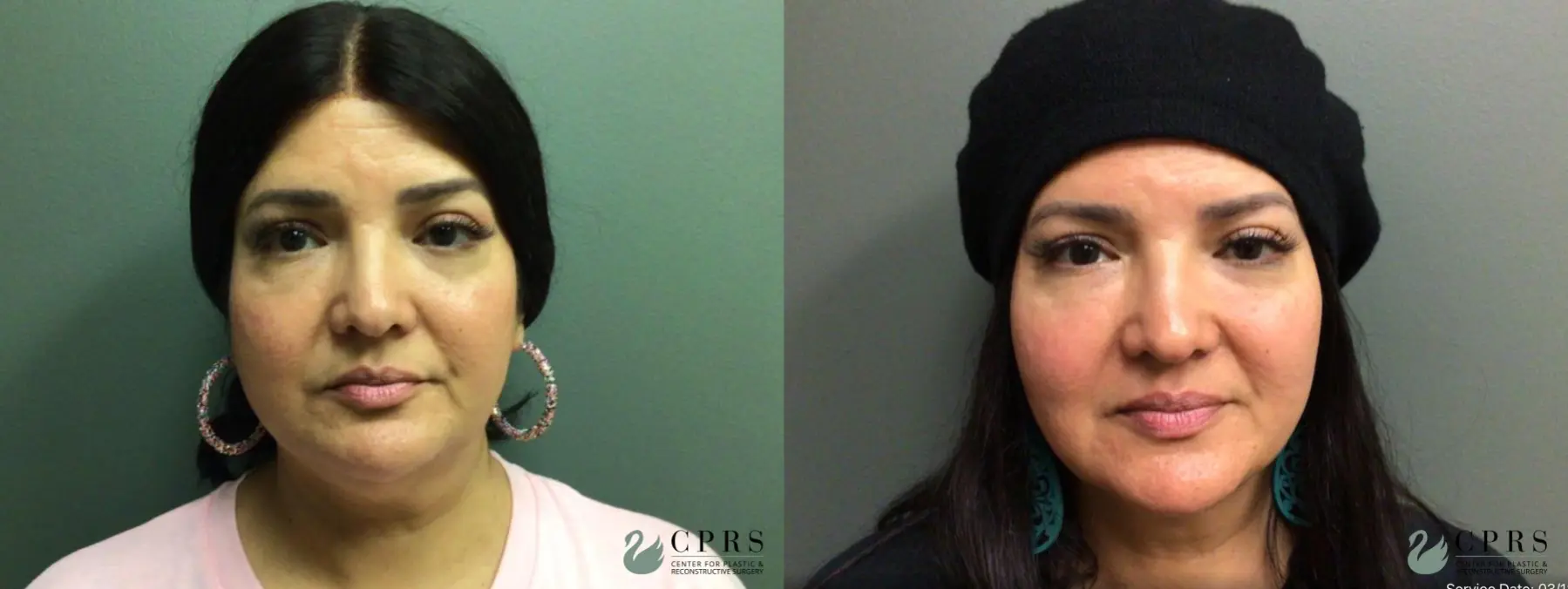 FaceTite: Patient 1 - Before and After  