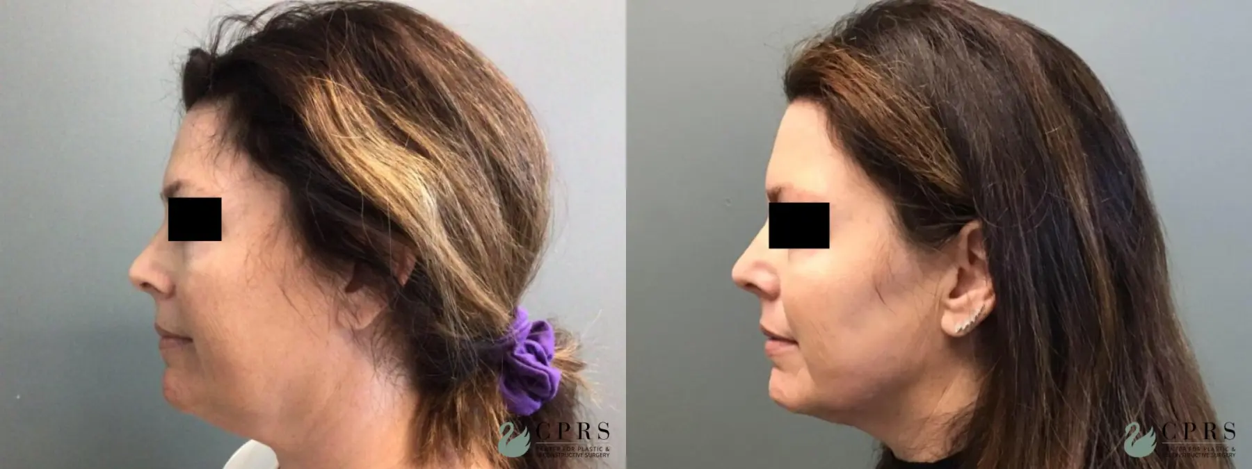 FaceTite: Patient 5 - Before and After 3