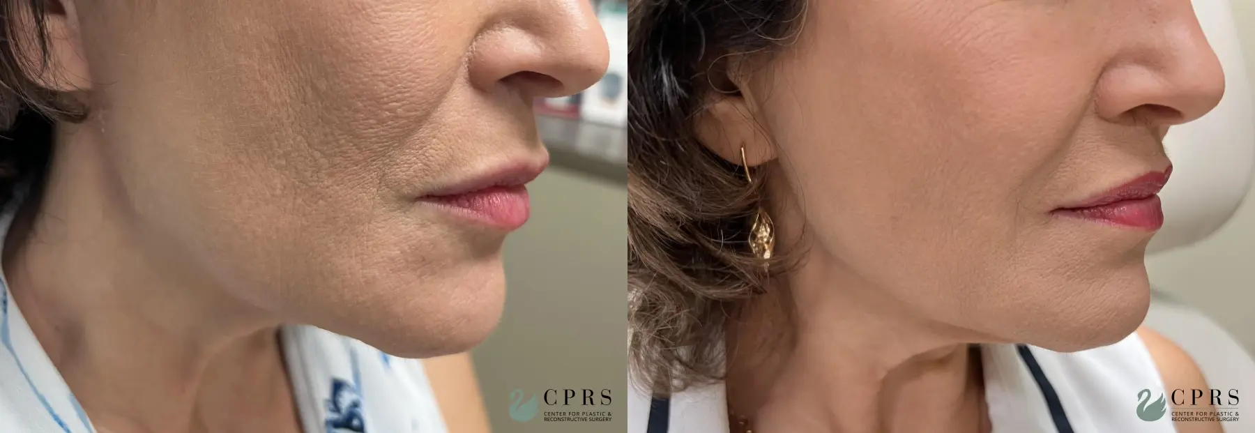 Fillers: Patient 2 - Before and After  