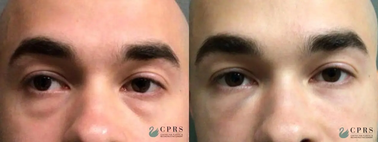 Fillers: Patient 1 - Before and After  