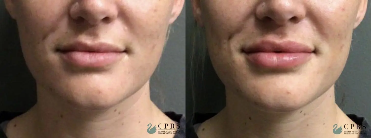Fillers: Patient 5 - Before and After  
