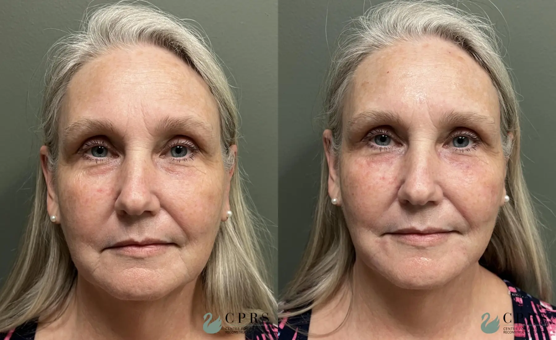 Fillers: Patient 3 - Before and After  