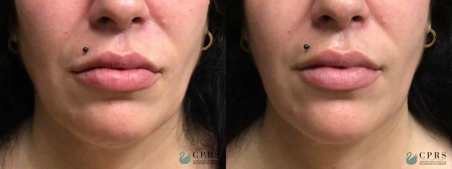 Fillers: Patient 4 - Before and After  