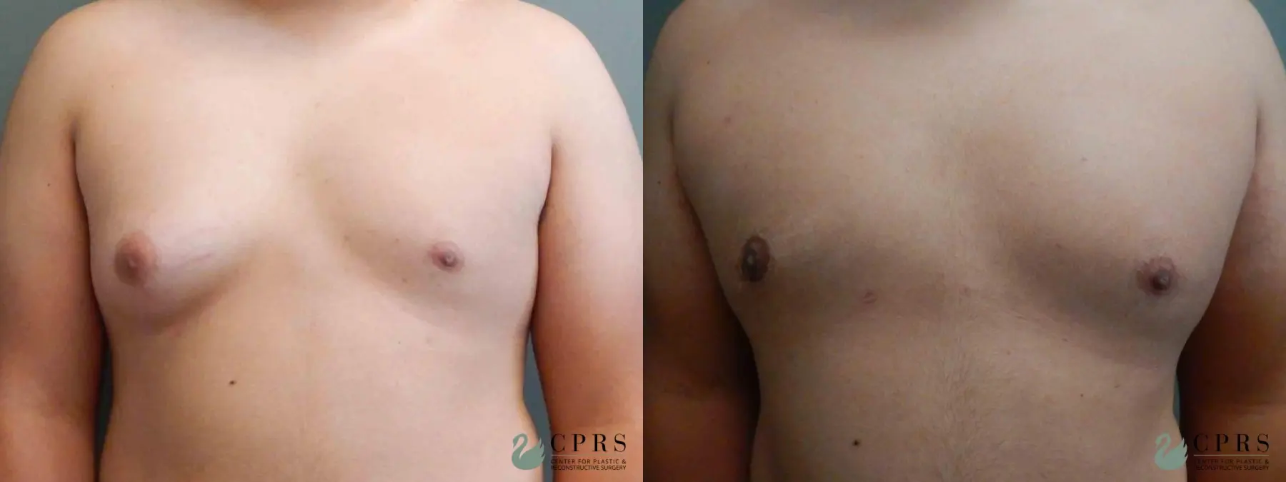 Gynecomastia: Patient 5 - Before and After  