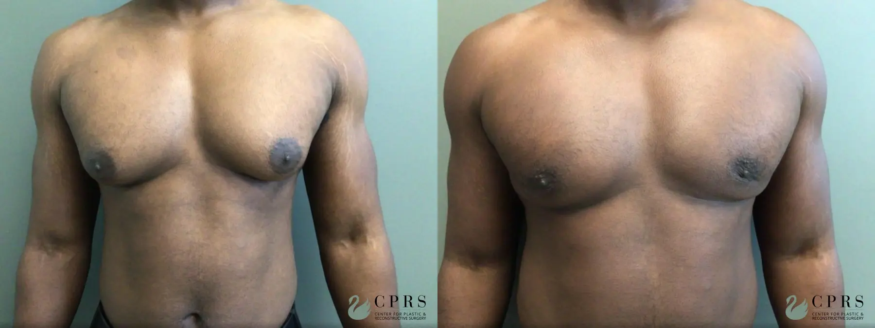 Gynecomastia: Patient 7 - Before and After  