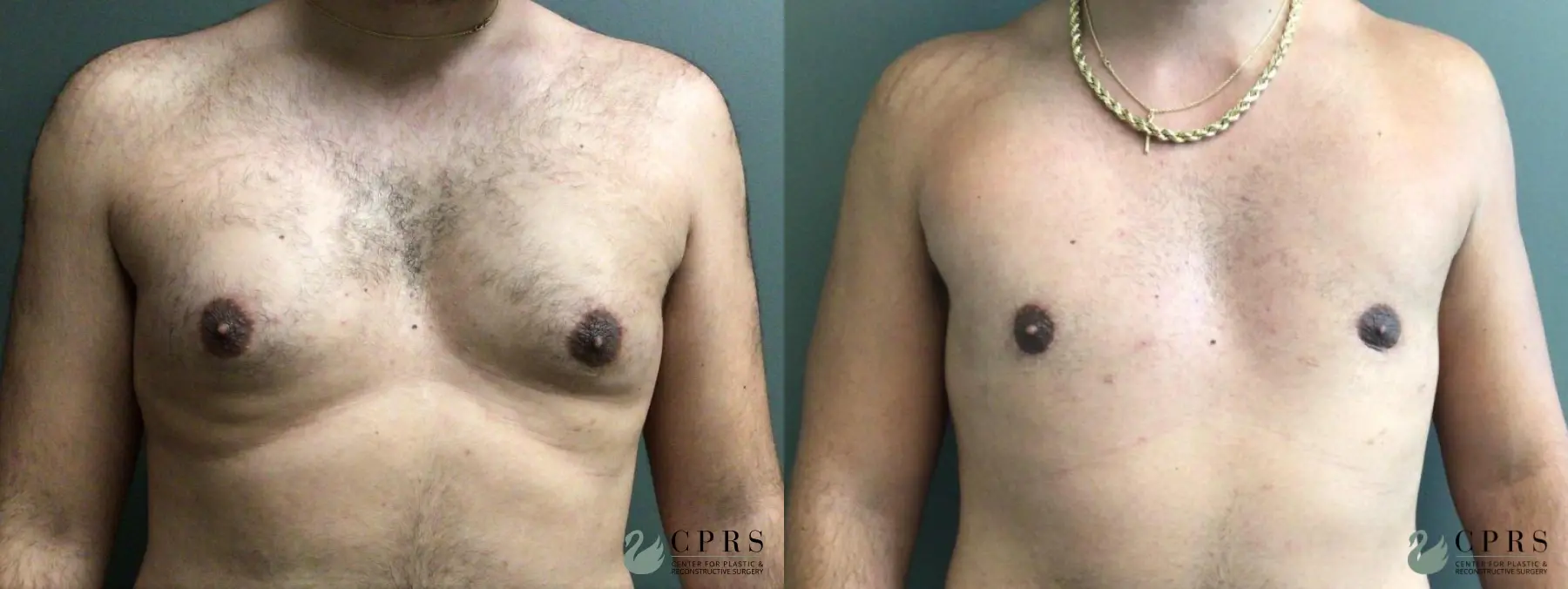 Gynecomastia: Patient 6 - Before and After  