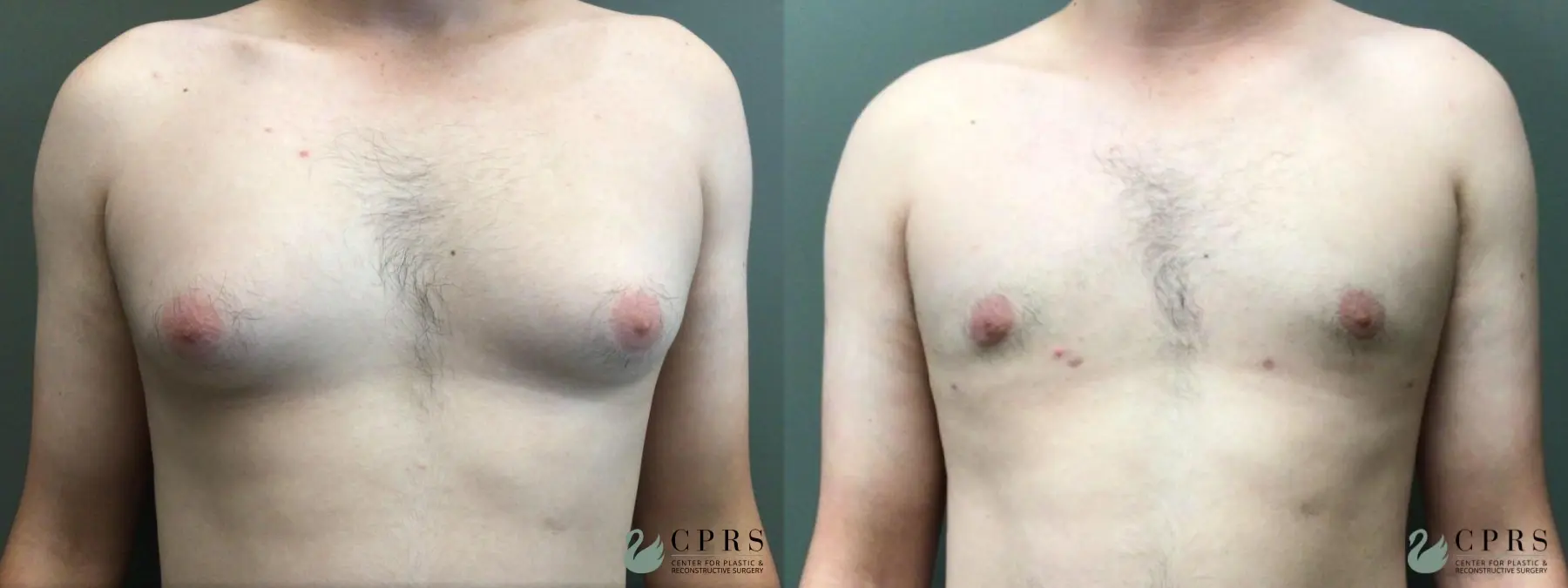 Gynecomastia: Patient 3 - Before and After  