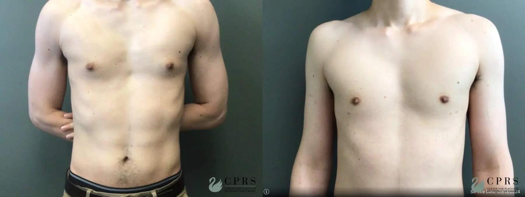 Gynecomastia: Patient 9 - Before and After  