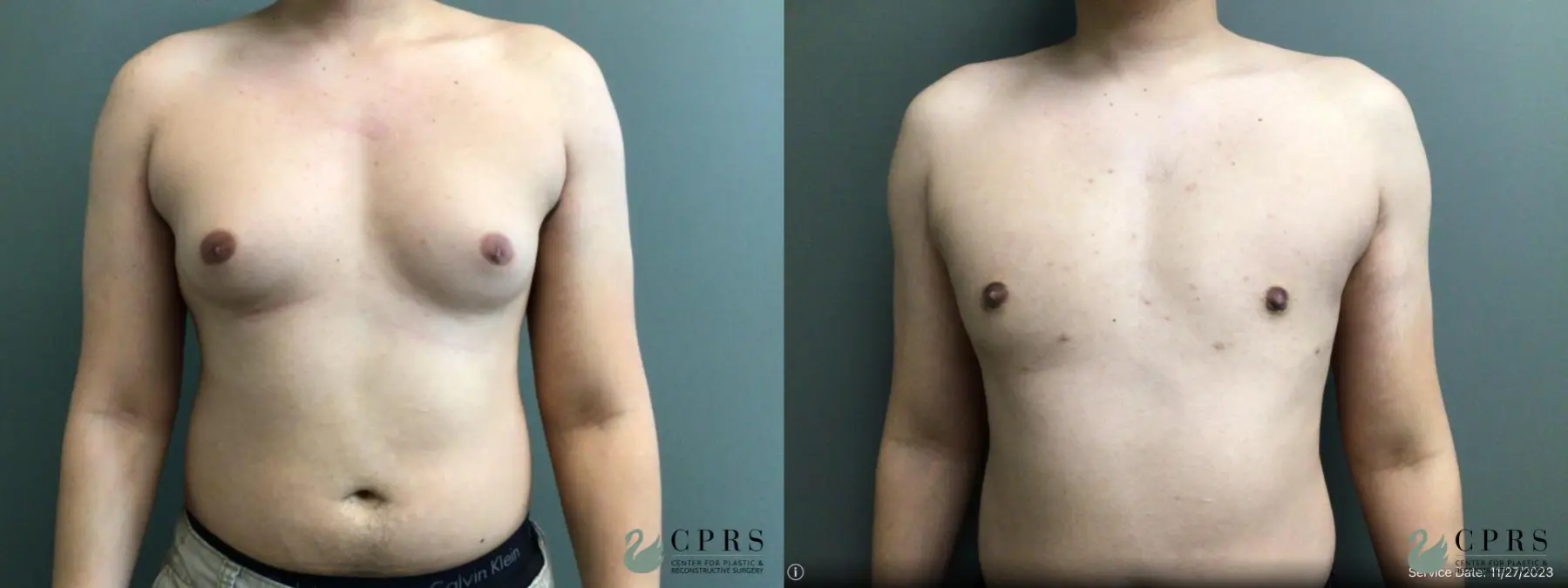 Gynecomastia: Patient 7 - Before and After  