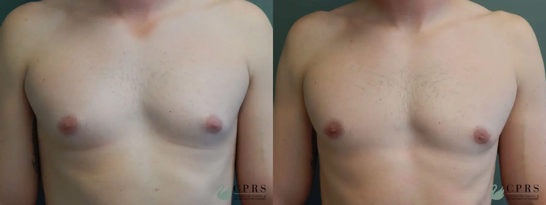 Gynecomastia: Patient 2 - Before and After  