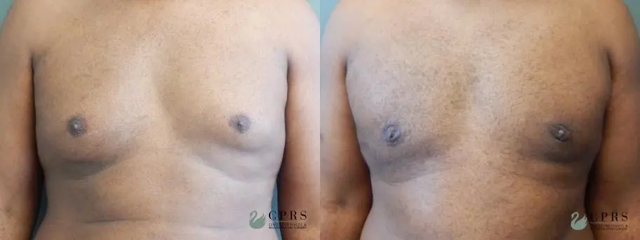 Gynecomastia: Patient 4 - Before and After  