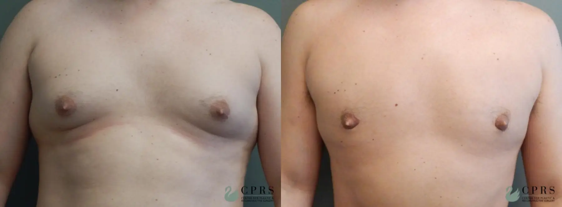 Gynecomastia: Patient 1 - Before and After  