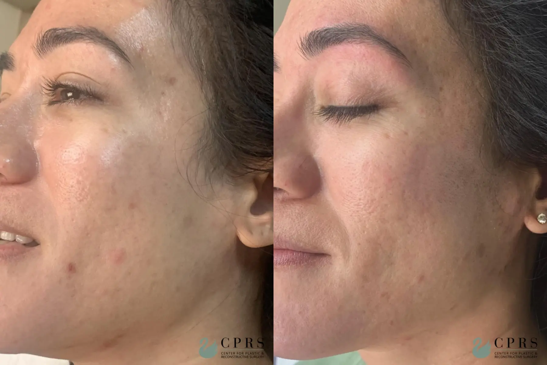 Hydrafacial: Patient 1 - Before and After  