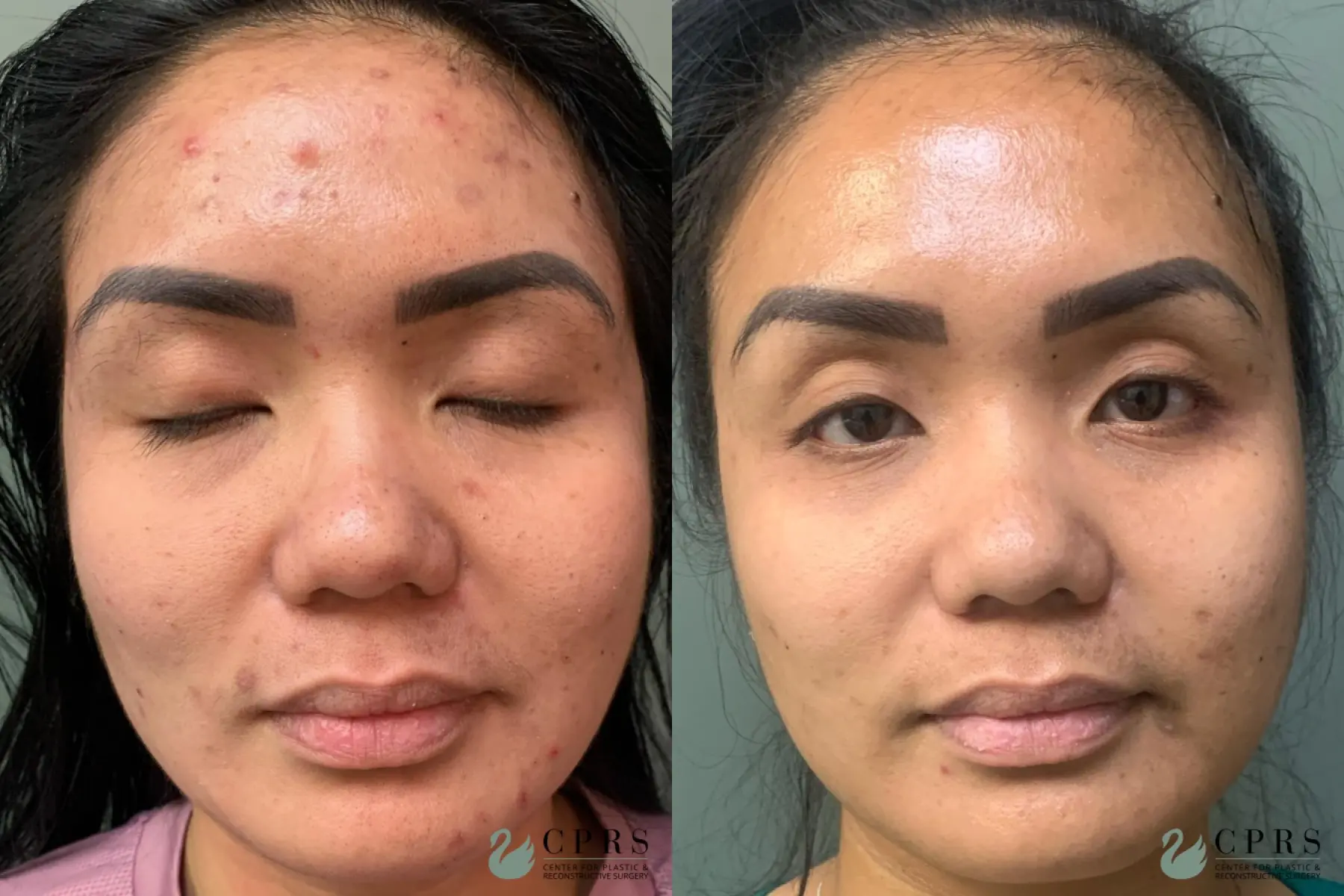 Hydrafacial: Patient 2 - Before and After  