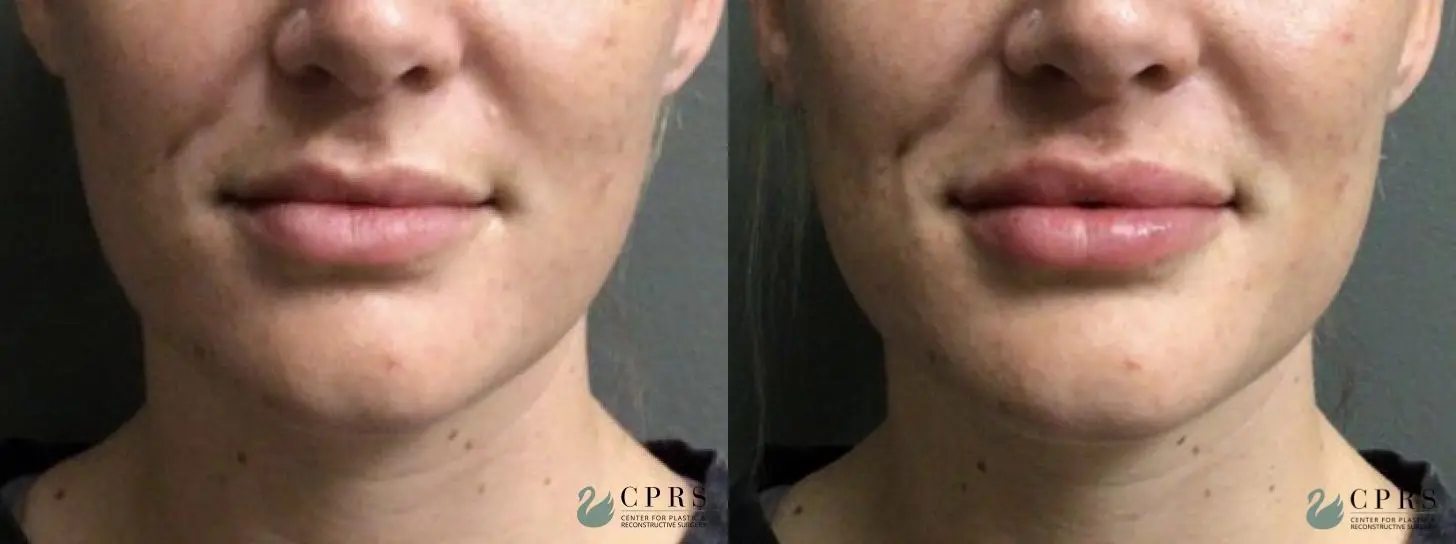 Injectables: Patient 2 - Before and After  