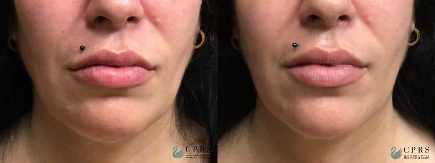 Injectables: Patient 3 - Before and After  
