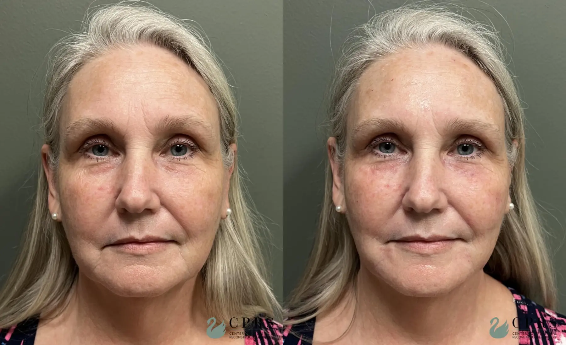 Injectables: Patient 1 - Before and After  