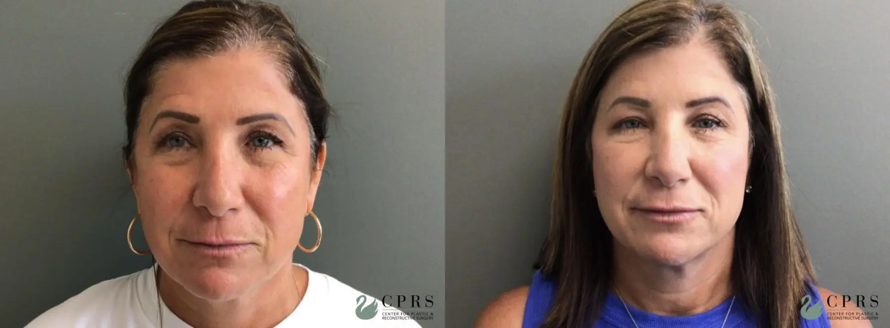 Injectables: Patient 7 - Before and After  