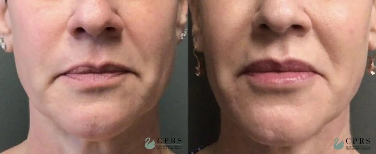 Injectables: Patient 4 - Before and After  