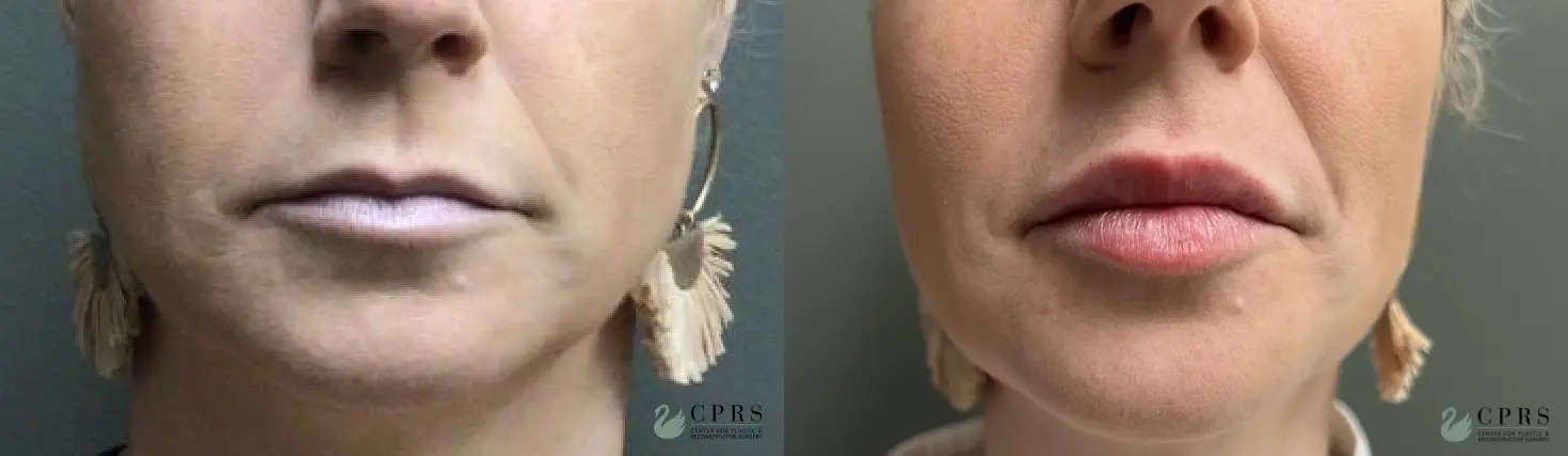 Injectables: Patient 8 - Before and After  