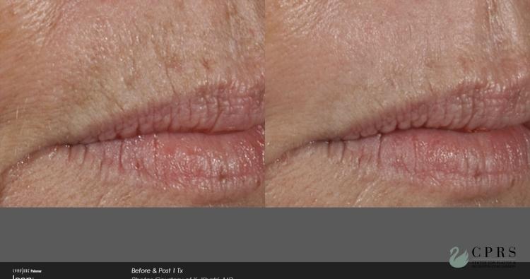 Laser: Patient 12 - Before and After 