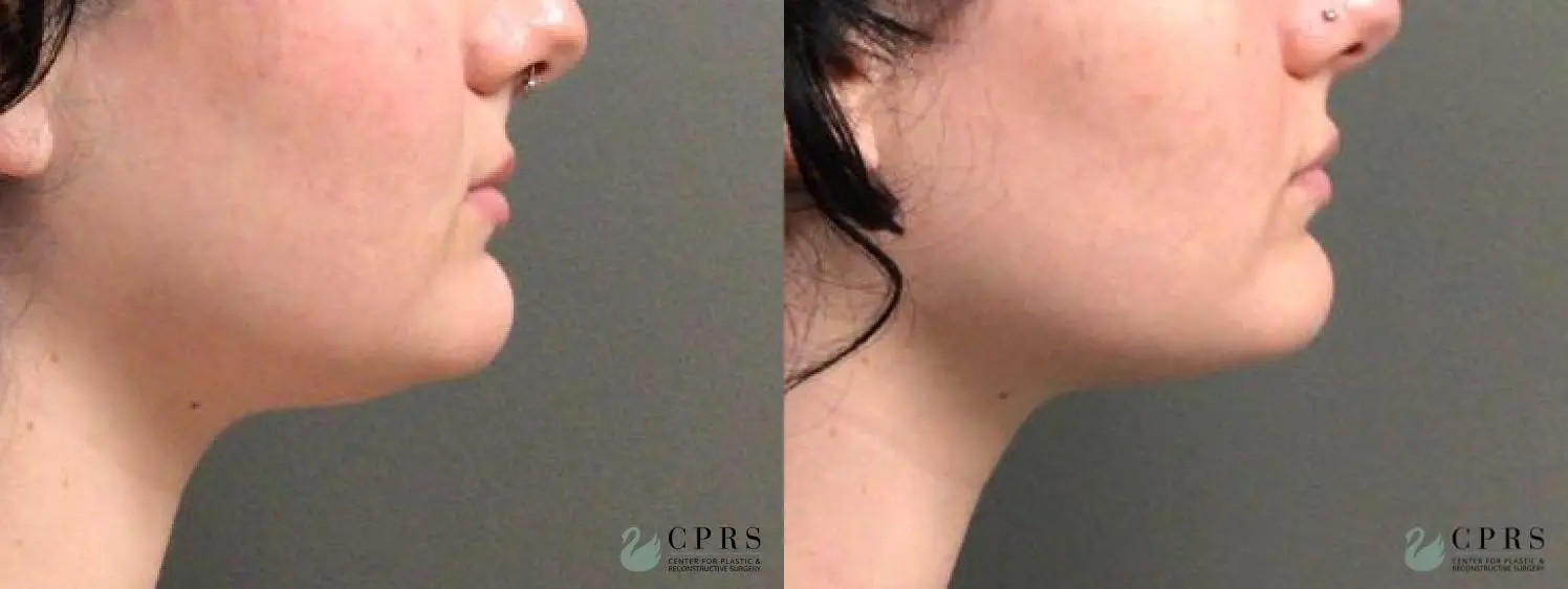 Kybella: Patient 3 - Before and After  
