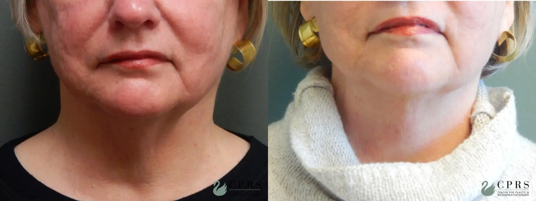 Kybella: Patient 2 - Before and After  