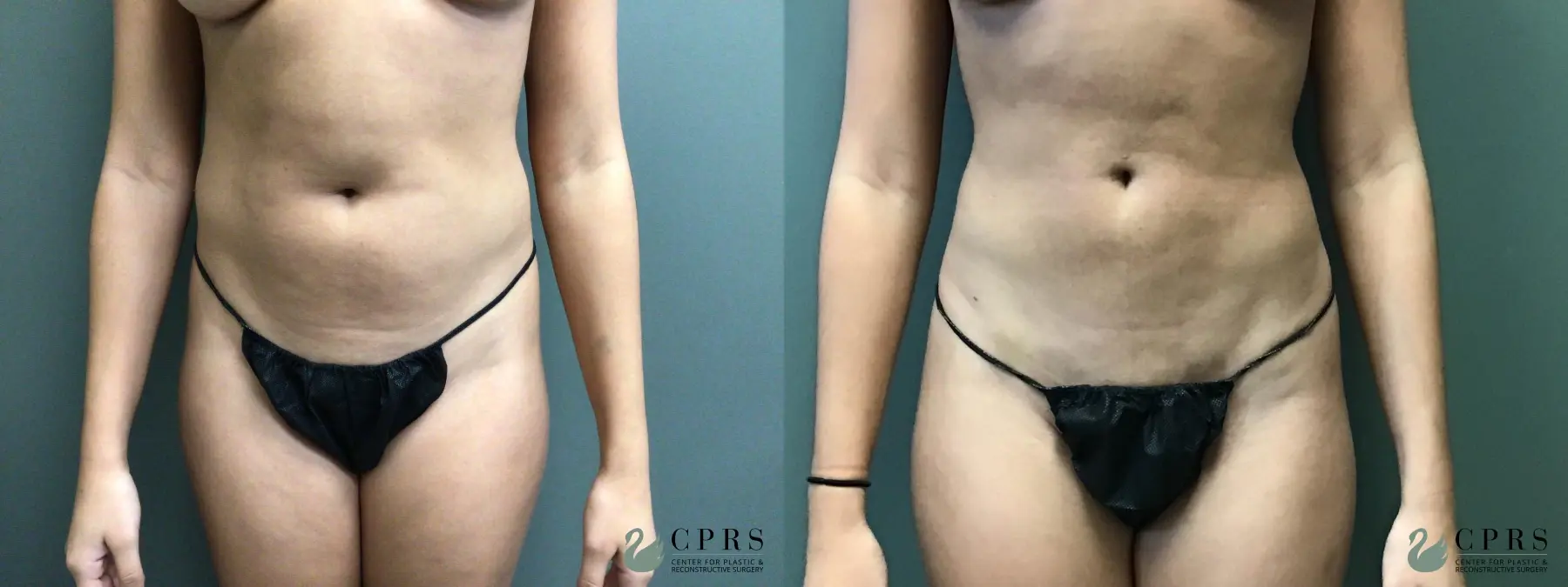 Liposuction: Patient 1 - Before and After  
