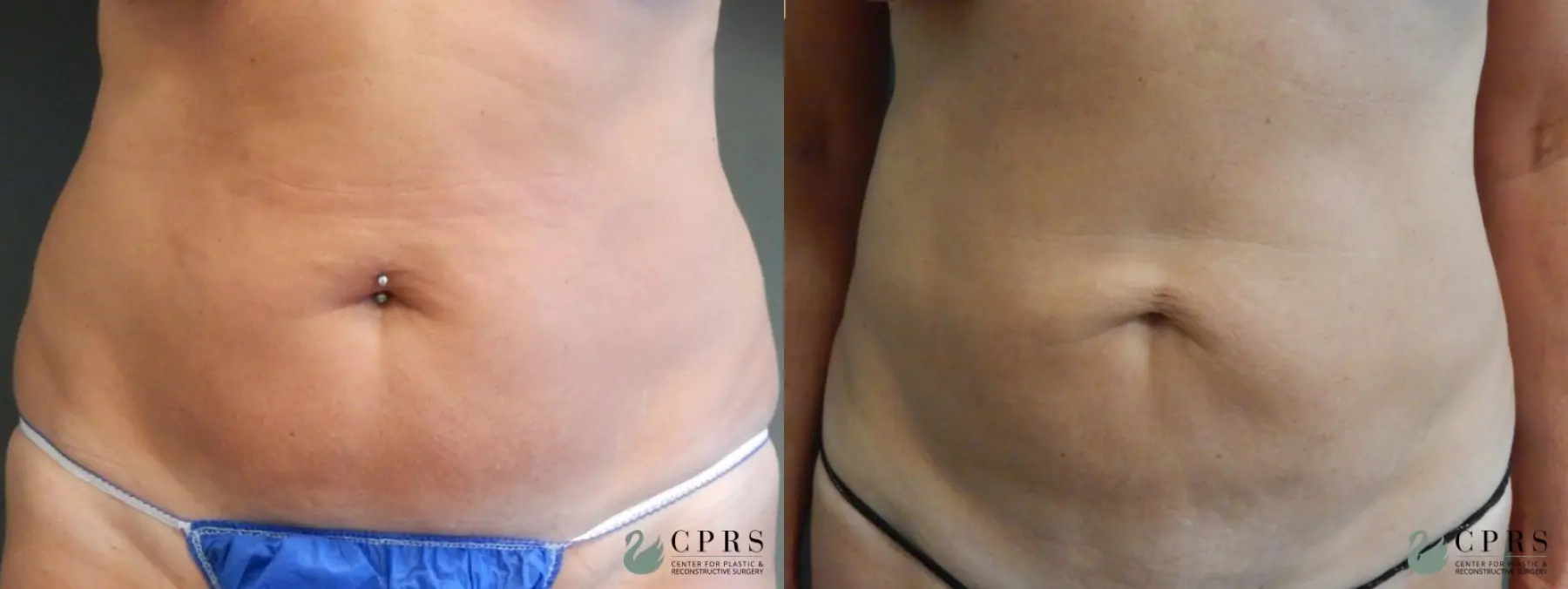 Liposuction: Patient 5 - Before and After  