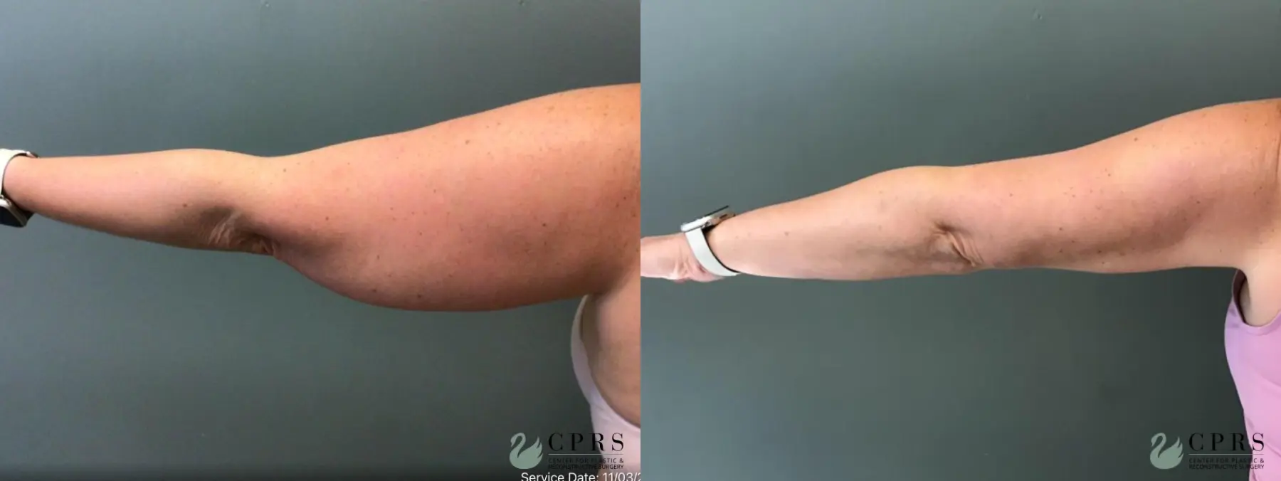 Liposuction: Patient 21 - Before and After 2