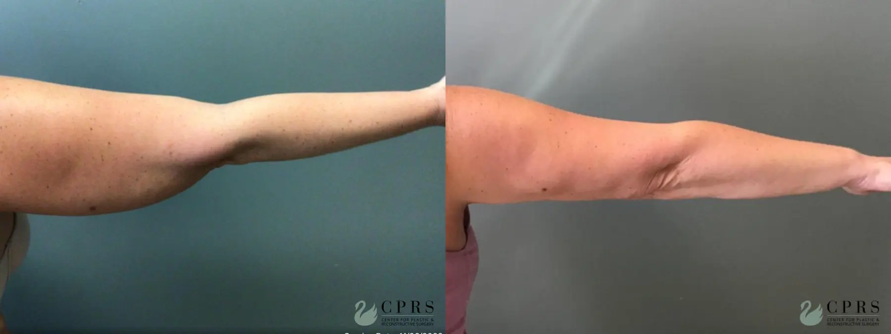 Liposuction: Patient 17 - Before and After  