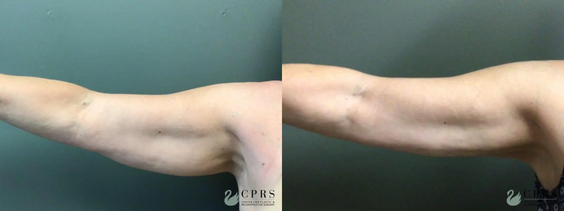 Liposuction: Patient 15 - Before and After  