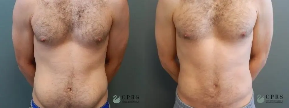 Liposuction: Patient 10 - Before and After  