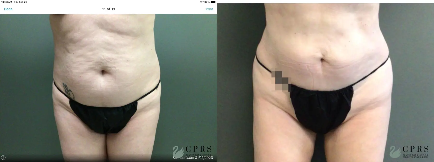 Liposuction: Patient 20 - Before and After  