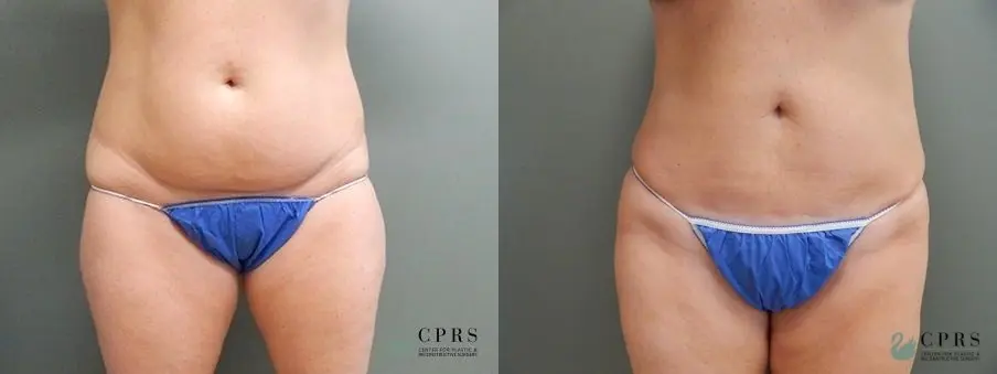 Liposuction: Patient 2 - Before and After  