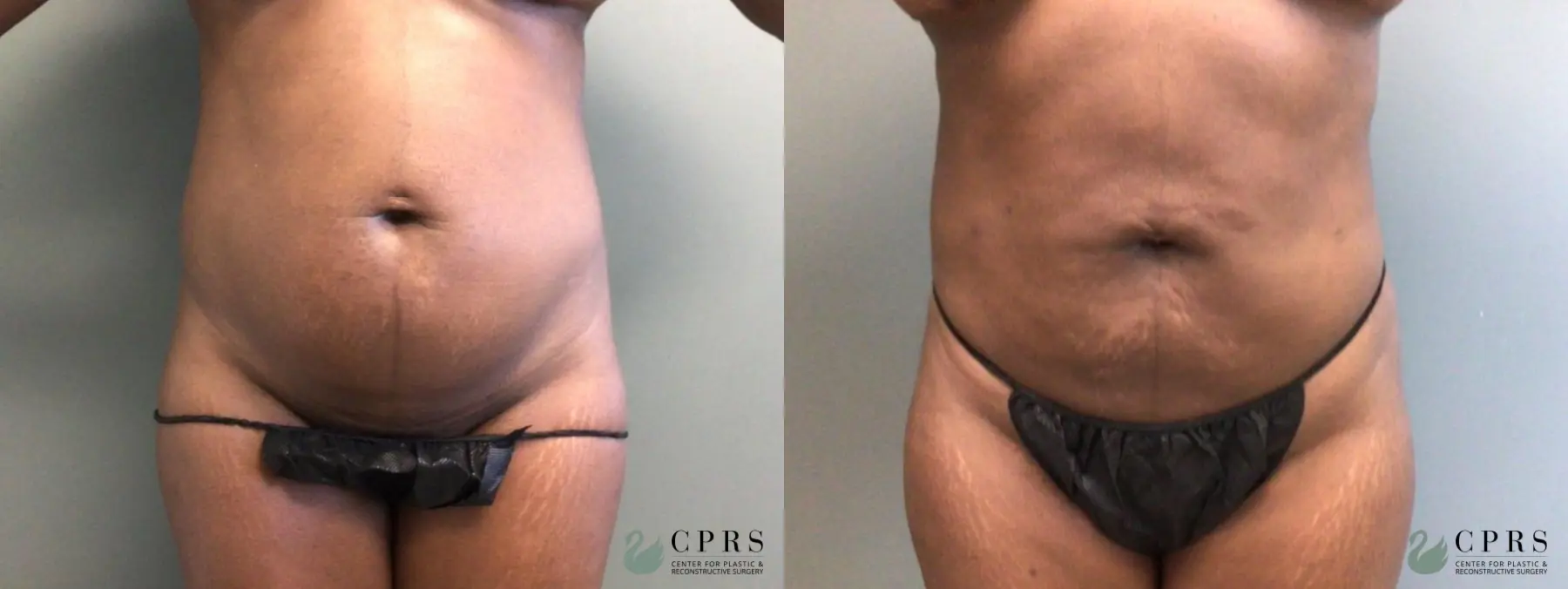 Liposuction: Patient 16 - Before and After  