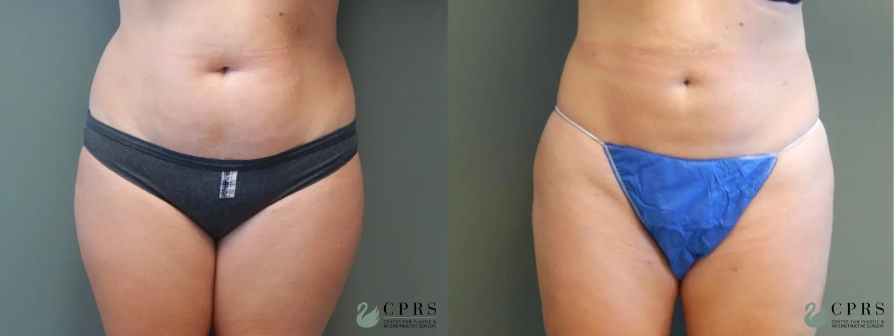 Liposuction: Patient 4 - Before and After  