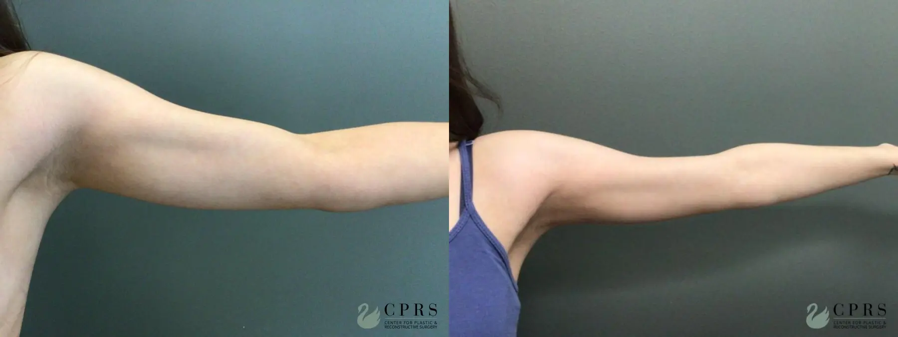 Liposuction: Patient 15 - Before and After  