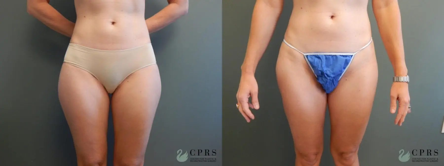 Liposuction: Patient 3 - Before and After  