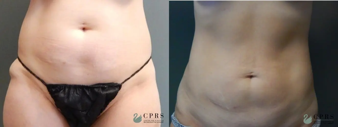 Liposuction: Patient 13 - Before and After  